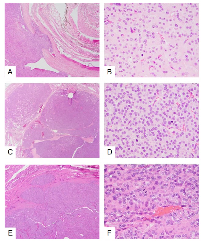 年轻低分化甲状腺癌代表性病理组织切片与分子特征对比