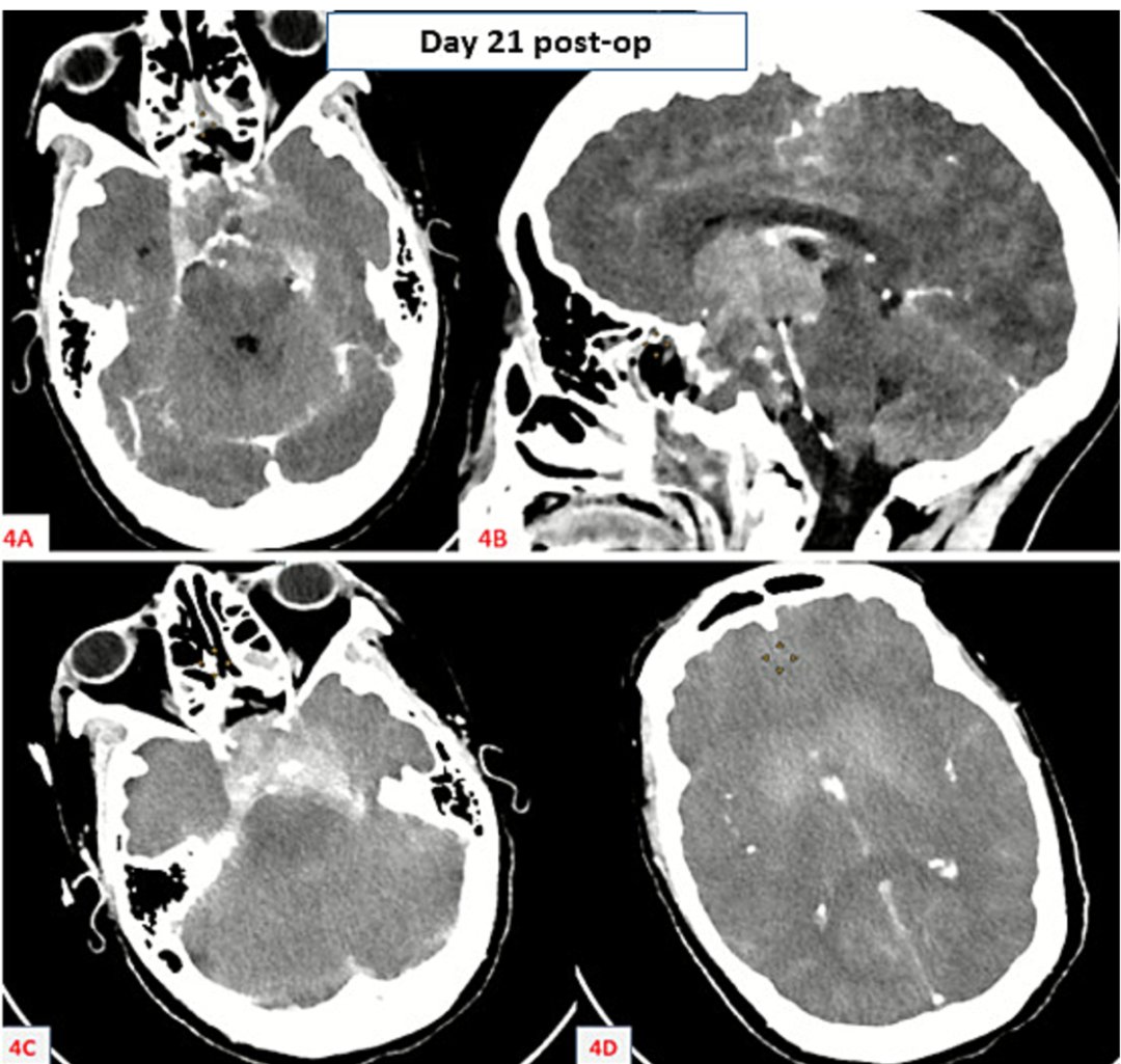 头颅CT检查显示基底动脉重度受压狭窄及中脑水肿
