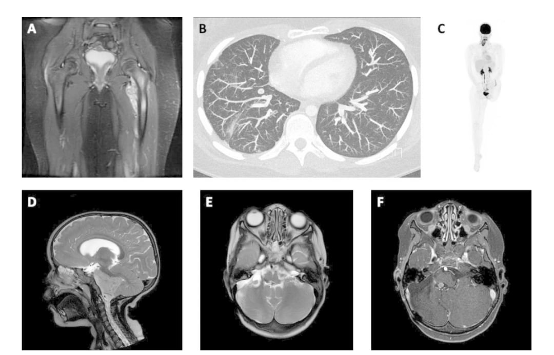 骨肉瘤与室管膜瘤患者影像学MRI、CT及PET病灶图示