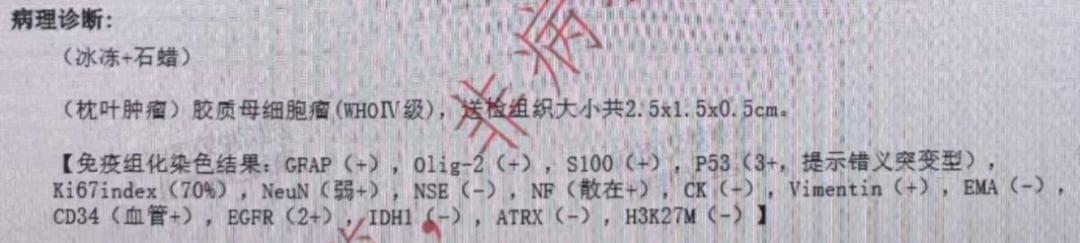 脑胶质母细胞瘤病理诊断报告示意图