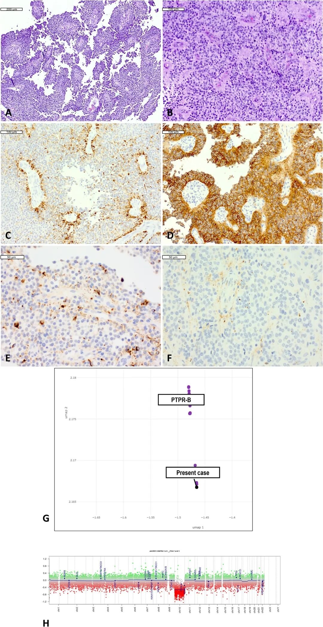 松果体区乳头状肿瘤组织学、免疫组化与DNA甲基化分子特征
