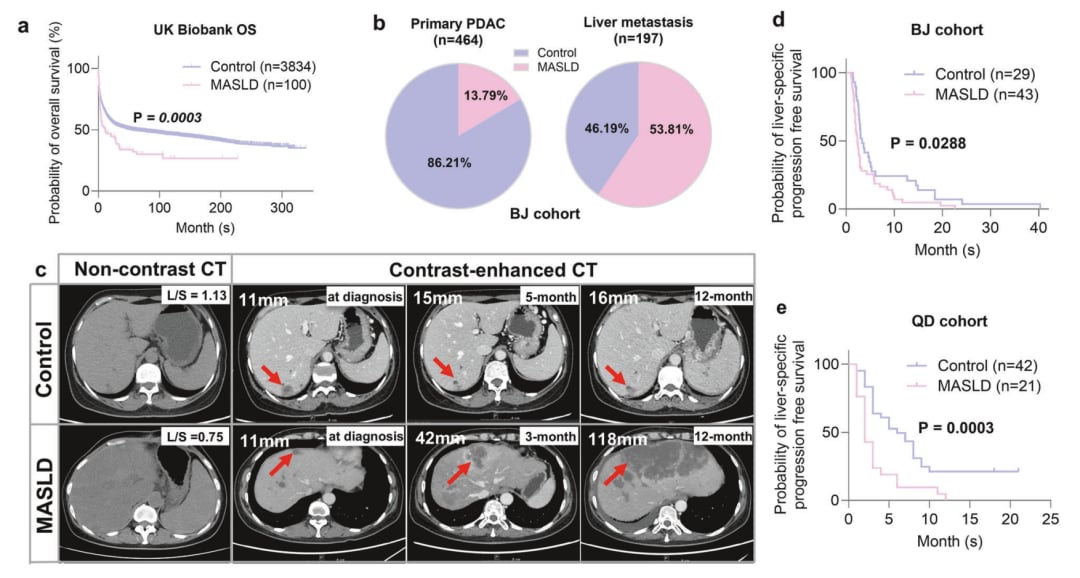 警惕!脂肪肝如何加速胰腺癌肝转移?最新研究揭示MIF-CD44新靶点 2 9c1cb4cb75b74ac88e43b506eb16645a-tndBBE0