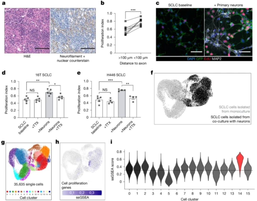 小细胞肺癌(SCLC)脑转移新突破:Nature揭示癌细胞“劫持”大脑通信,治疗迎来转机 2 b0ce5edf2c6c459da88f1cbdcc7065d5-ciyzW19