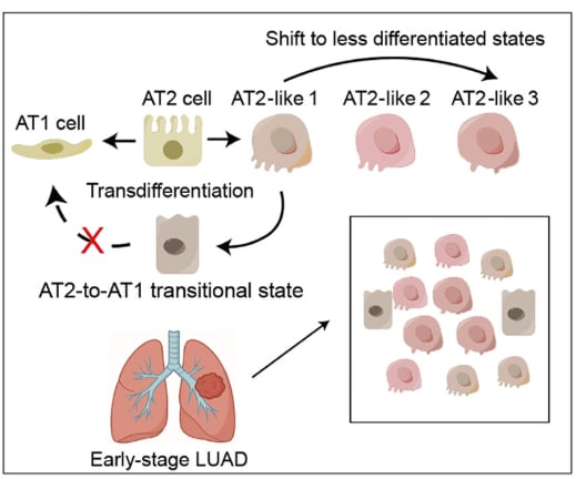 早期肺腺癌治疗新希望:揭秘KLF4/JDP2如何“重编程”癌细胞,突破异质性难题 2 KLF4和JDP2介导肺腺癌重编程及进展抑制机制模式图