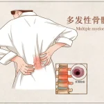 破解多发性骨髓瘤耐药密码：MCL1抑制剂研发三十年，为复发患者带来新曙光