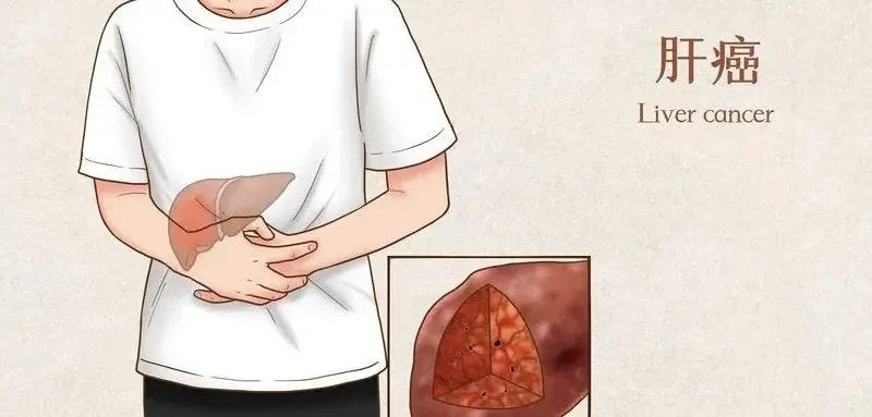 肝癌