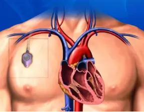 经输液港输液,6 个最容易被忽略的冷知识 1 图片