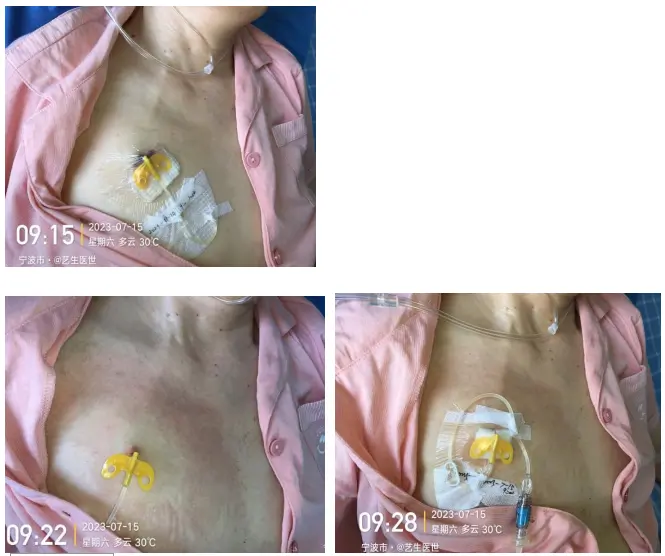 经输液港输液,6 个最容易被忽略的冷知识 11 图片