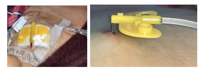 经输液港输液,6 个最容易被忽略的冷知识 14 图片