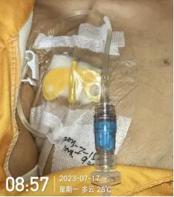 经输液港输液,6 个最容易被忽略的冷知识 16 图片