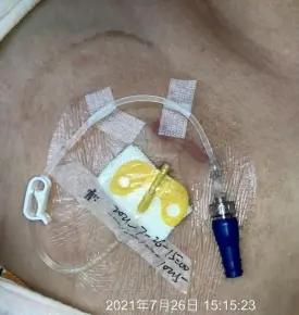 经输液港输液,6 个最容易被忽略的冷知识 5 图片