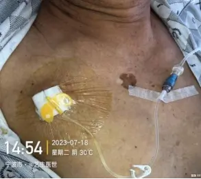 经输液港输液,6 个最容易被忽略的冷知识 6 图片