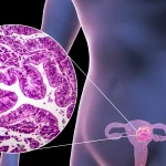 子宫内膜癌精准分型新突破：首例POLE新发突变揭示复杂分子表型，如何影响治疗与预后？