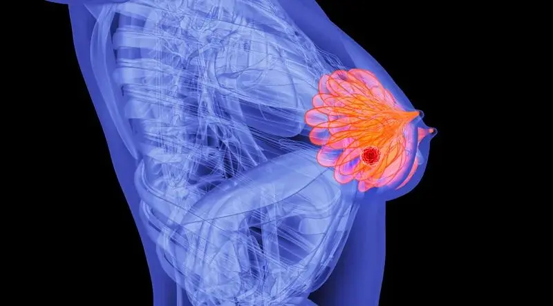 ​美国新研究：乳腺癌发生转移的“关键开关”被发现！