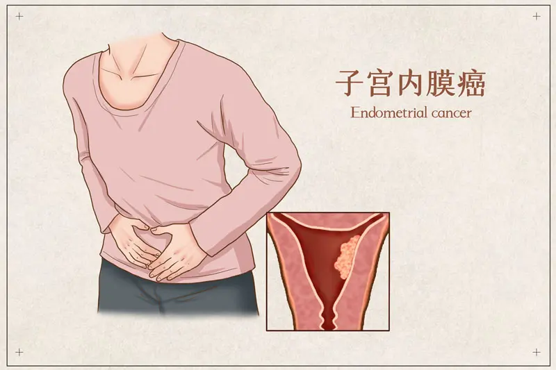 有效率90%以上，近六成患者肿瘤大幅缩小或消失，晚期子宫内膜癌ADC新药BNT323/DB-1303来袭