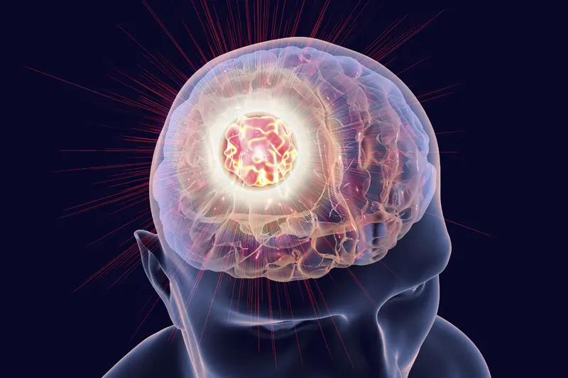 易普利姆玛/纳武利尤单抗与放疗时机如何影响脑损伤风险？