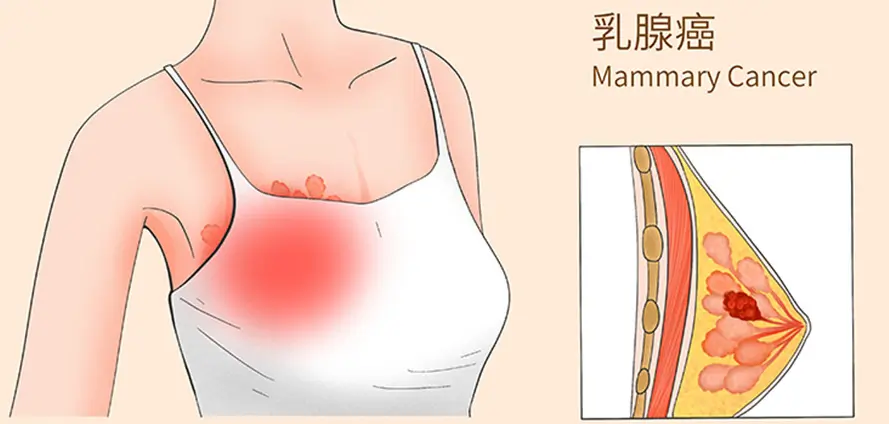 乳腺癌治疗后为何总复发？罪魁祸首或已被发现！