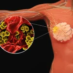 乳腺癌早期筛查：为何比症状发现更能挽救生命？