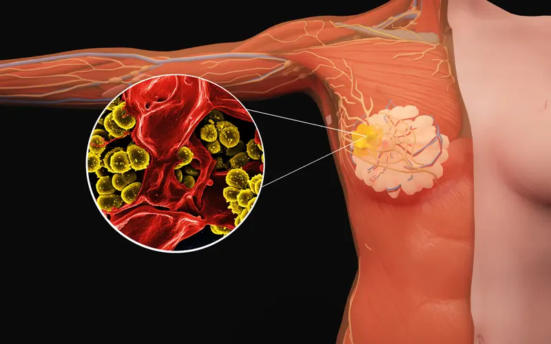 乳腺癌新疗法：58%患者肿瘤消失，治疗前景广阔