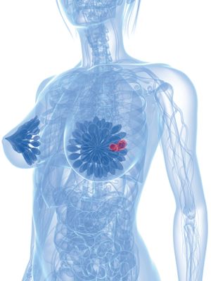 乳腺癌化疗新选择：艾贝格司亭α (亿立舒)降低中性粒细胞减少症风险