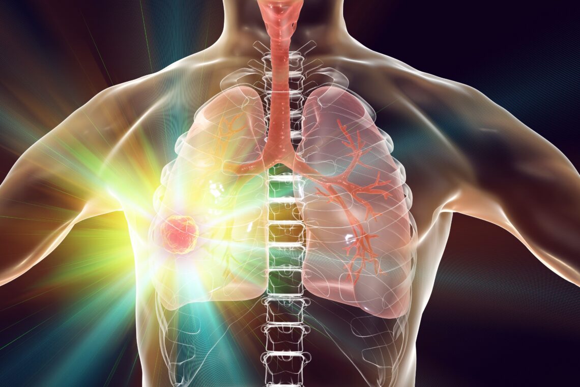 EGFR突变肺腺癌靶向治疗：奥希替尼、吉非替尼等药物的挑战与CML经验的启示