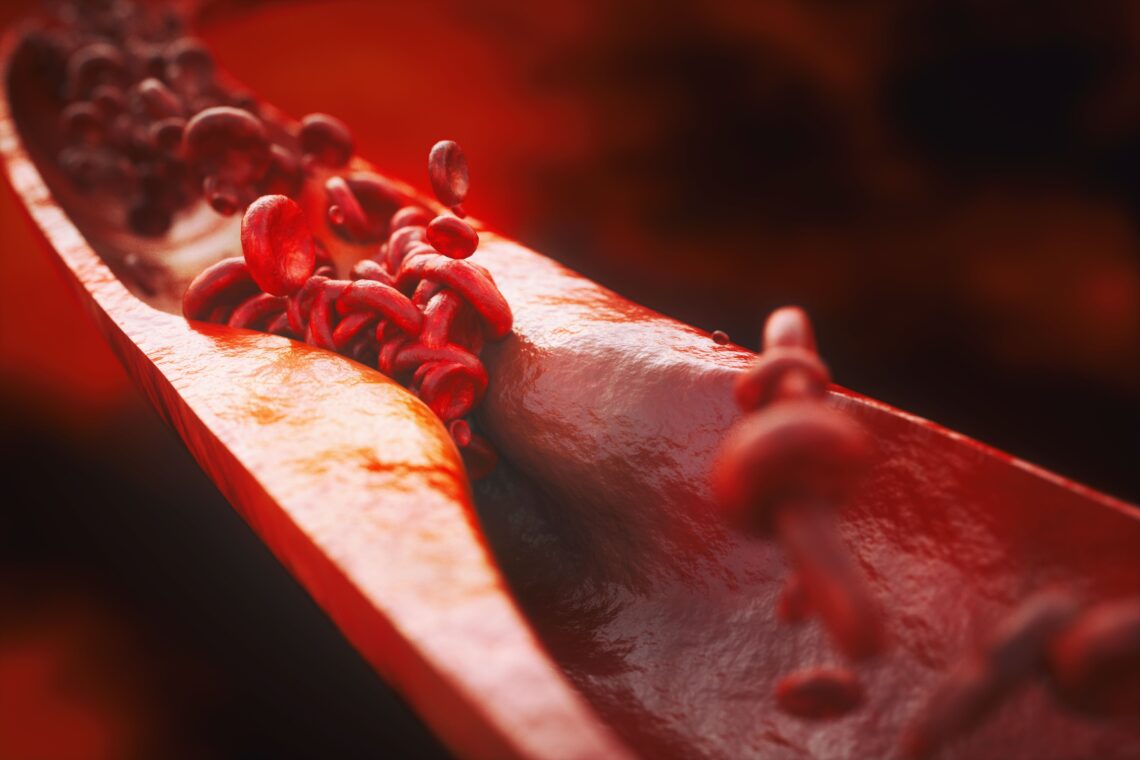 代谢综合征与乳腺癌预后：一项研究揭示复发和死亡风险显著增加