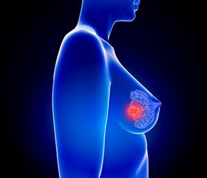 临床研究：提高年轻乳腺癌患者内分泌治疗依从性，显著改善无病生存期