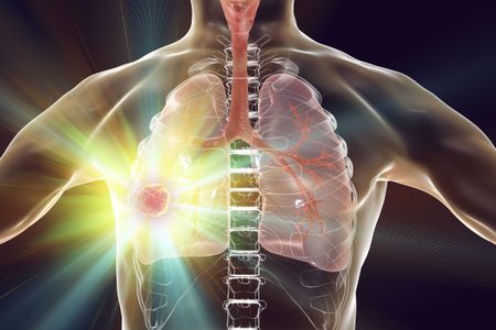 最新研究：肺癌筛查依从性随时间下降，早期发现的关键在哪里？