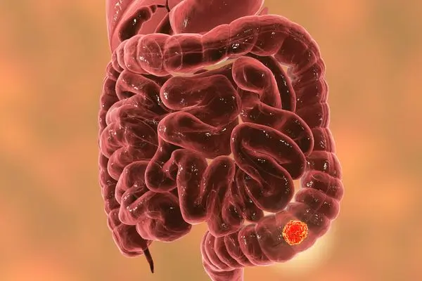 结直肠癌术后复发早发现：ctDNA液体活检的突破性临床研究