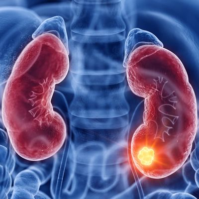 机器人辅助部分肾切除术新突破：肾肿瘤患者安全实现术后即日出院