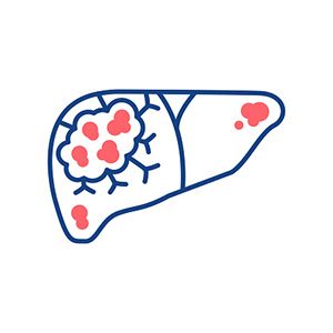 晚期肝细胞癌免疫治疗达到完全缓解：生存期显著延长且持久