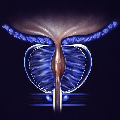 大型研究揭示：前列腺癌根治术与近距离放疗的长期泌尿生殖系统毒性风险较低