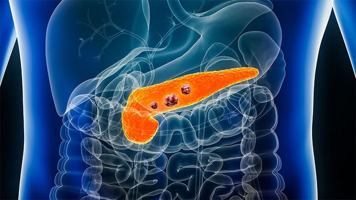最新研究：警惕！胰腺癌与结直肠癌在年轻人群中发病率显著上升