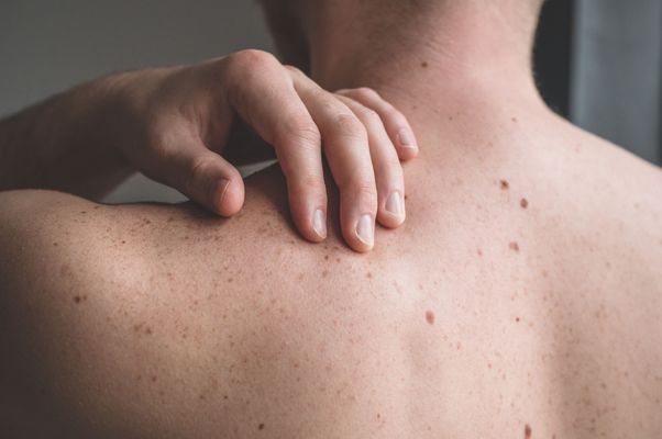 晚期黑色素瘤治疗新突破：Nurulimab联合Prolgolimab临床研究结果积极