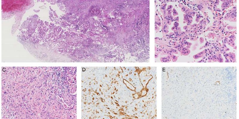 深入解析肺浸润性黏液腺癌：临床病理、分子特征与靶向治疗新进展