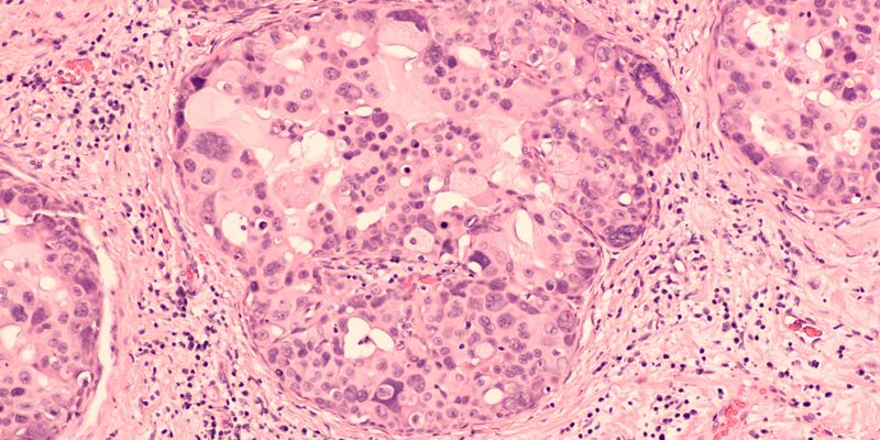 乳腺癌DCIS保乳术后，手术切缘不足2毫米还需要再次切除吗？一项新研究的启示