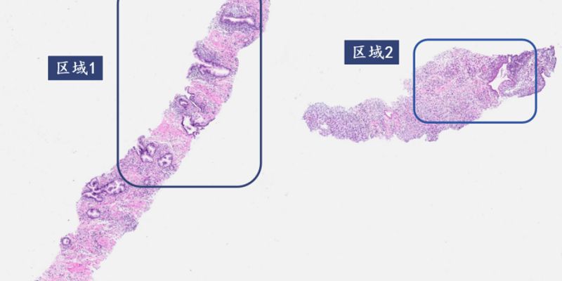 前列腺间质肿瘤深度解析：从良性增生到恶性肉瘤的精准诊断与鉴别