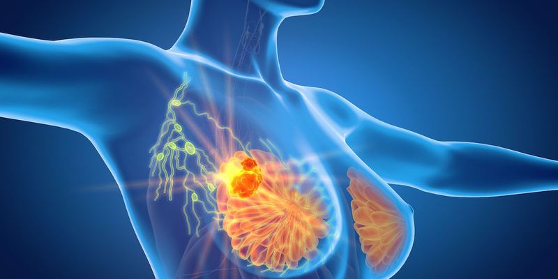 乳腺癌治疗新视野：基因检测、手术策略与精准靶向治疗