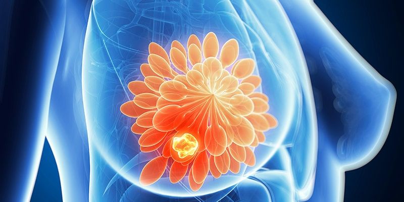 BRCA基因突变乳腺癌患者福音：预防性放疗显著延缓对侧乳腺癌发生