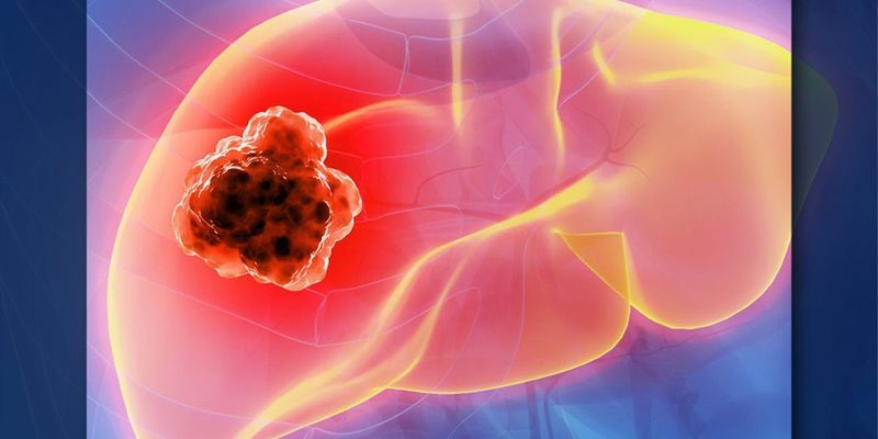 Botensilimab联合Balstilimab：为难治性肝细胞癌患者带来持久疗效新希望