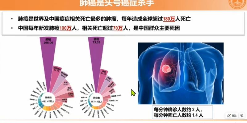 肺癌筛查新纪元：30年临床研究揭示低剂量CT普筛与AI辅助早期诊断的深远影响