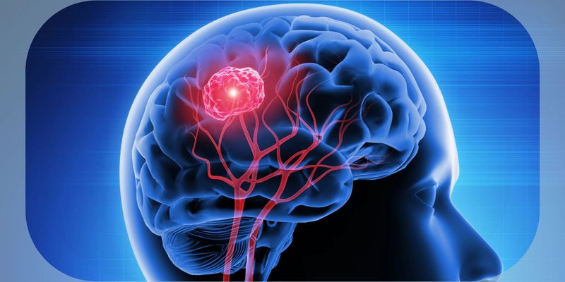 脑转移瘤治疗新进展：术前立体定向放射治疗的安全性与有效性研究