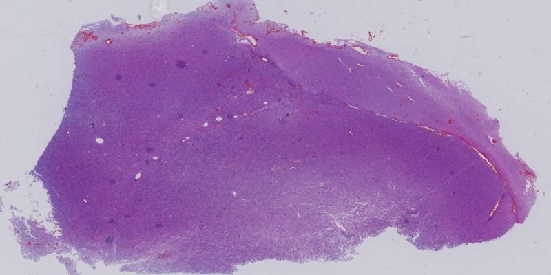 巨细胞胶质母细胞瘤诊断要点：病理特征、免疫组化与鉴别诊断深度解析