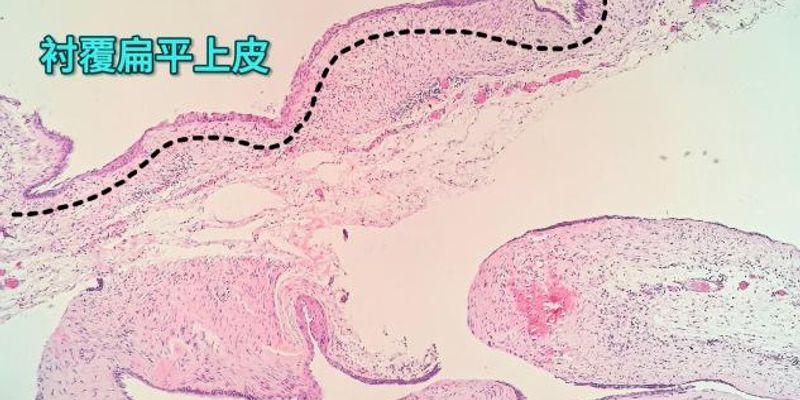 甲状舌管囊肿：从胚胎发育到病理诊断的全面解析
