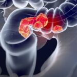 结直肠癌生存率新洞察：首发多原发癌患者预后为何更优？