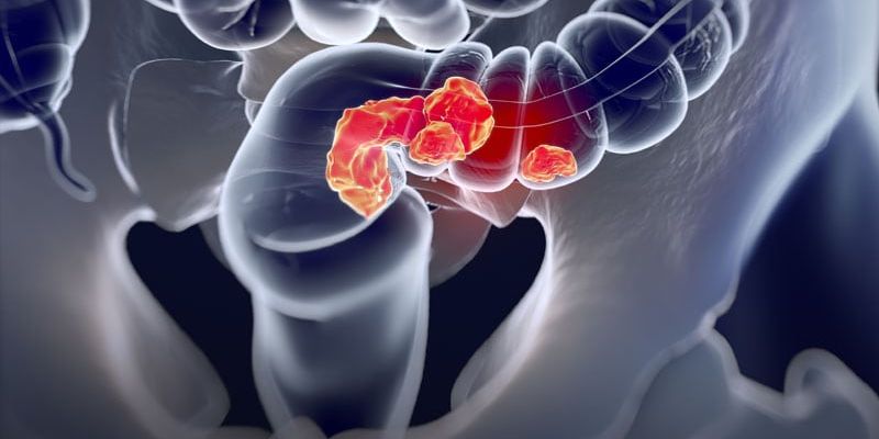 结直肠癌生存率新洞察：首发多原发癌患者预后为何更优？