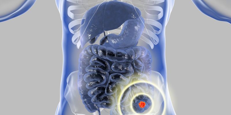 结直肠癌诊断顺序如何影响多原发恶性肿瘤患者生存期？最新研究揭示预后关键