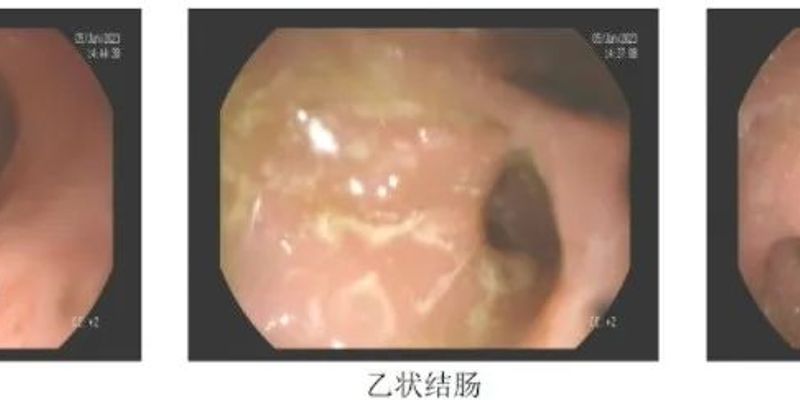 PD-1抑制剂治疗肺癌：警惕免疫相关性肠炎（ICIC）的诊断与管理