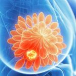 乳腺癌新辅助化疗后淋巴结转阴：区域淋巴结放疗是否可省略？