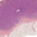 Merkel细胞癌（MCC）全面解析：诊断、病理特征与靶向免疫治疗进展